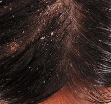 Dobry szampon przeciwłupieżowy - przyda się jesienią i zimą Dobry szampon przeciwłupieżowy - przyda się jesienią i zimą