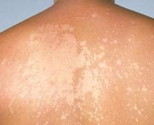 Łupież pstry - geneza, zapobieganie, leczenie Łupież pstry - geneza, zapobieganie, leczenie