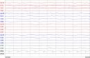 Badania diagnostyczne w padaczce Badania diagnostyczne w padaczce