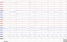 Co to jest padaczka?