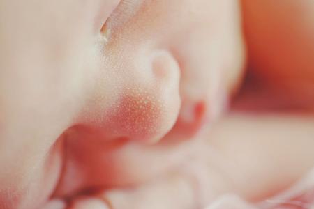 zaczopowanie gruczołów łojowych