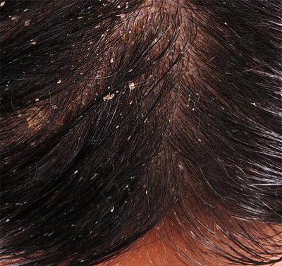 łupież łojotokowy