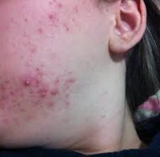 Trądzik - co robić by pozbyć się pryszczy